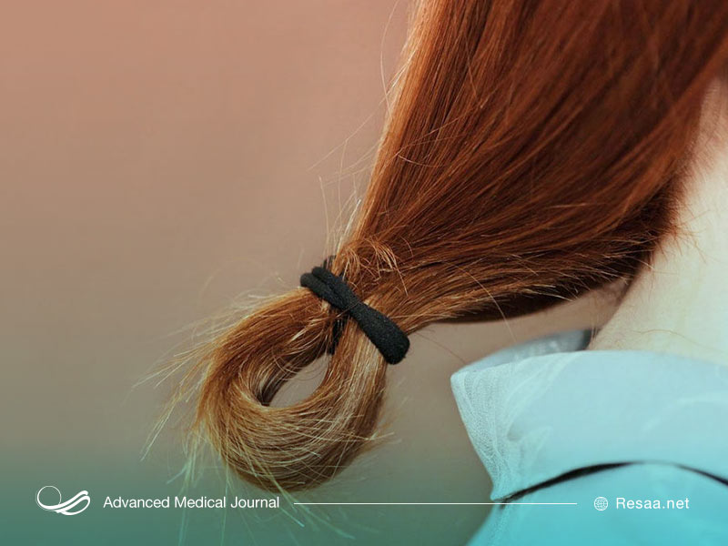 کش‌های مو و ایجاد موخوره