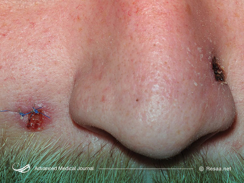 علایم سفلیس