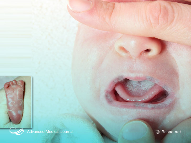 نوزاد و تاثیرات سفلیس