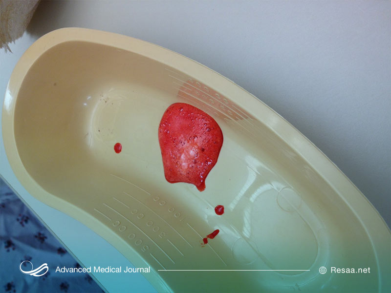 خون بالا اوردن هنگام تنفس