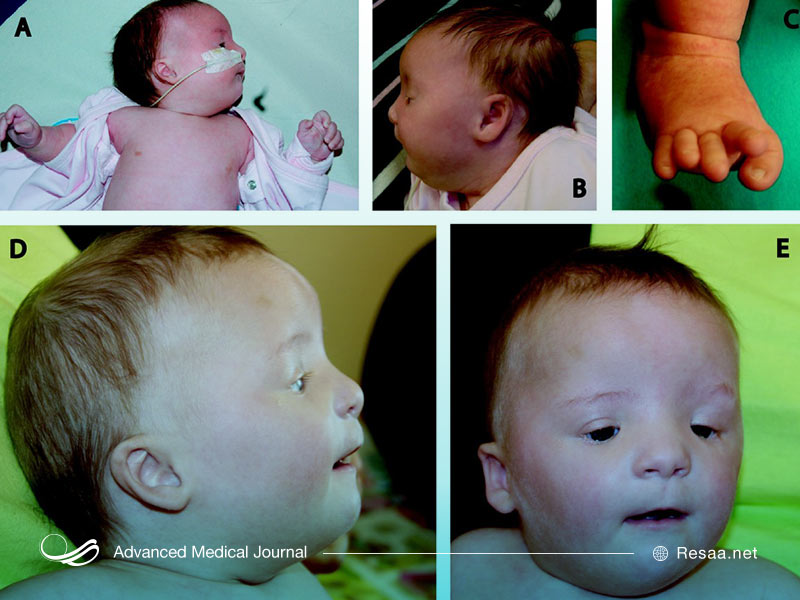 این بیماری می‌تواند ارثی باشد