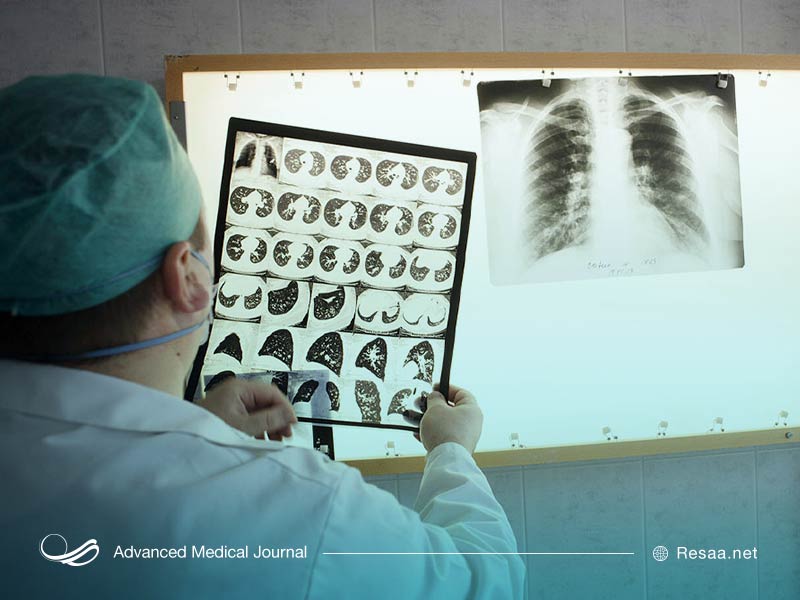 علایم بیماری سل