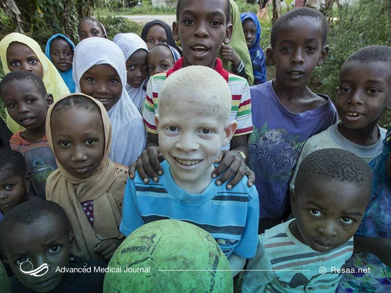 آلبینیسم یا زالی