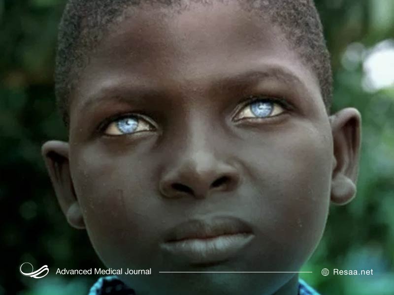 آلبینیسم چشمی پوستی