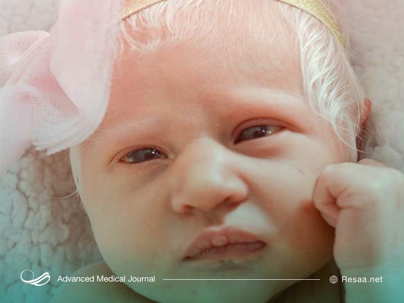 سفیدی موها در البینیسم