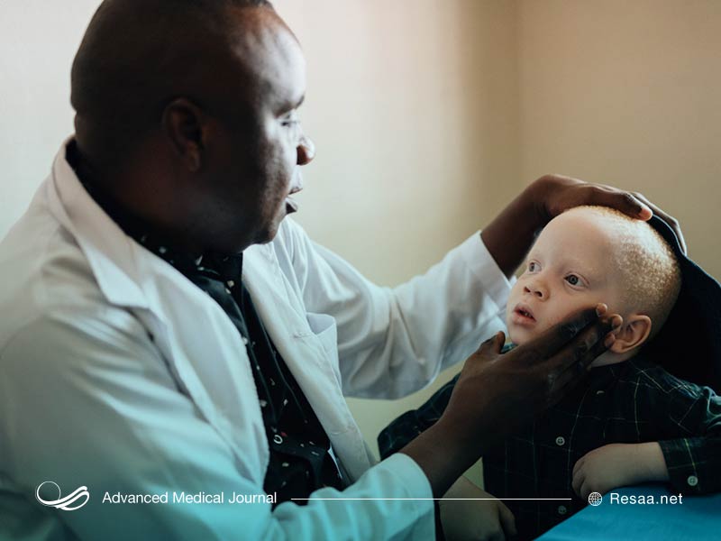 شناسایی آلبینیسم