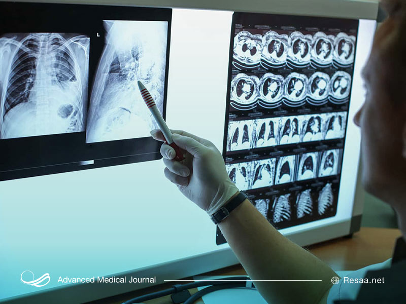 بررسی عکس قفسه سینه