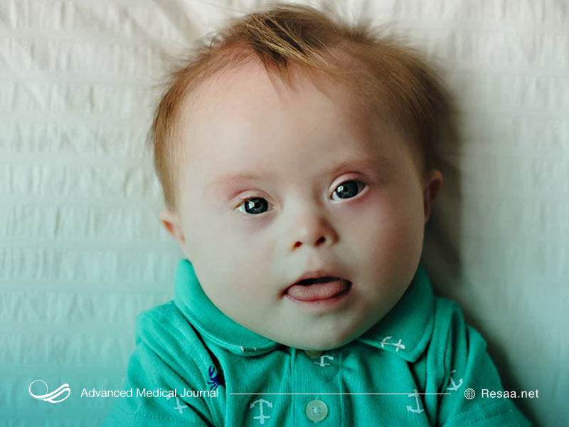 سندروم داون چیست؟