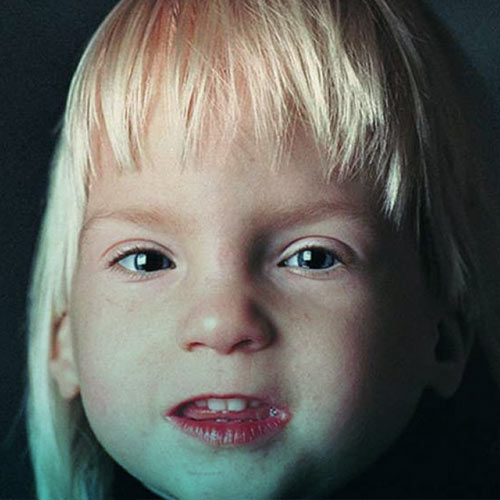 سندروم الکل جنین