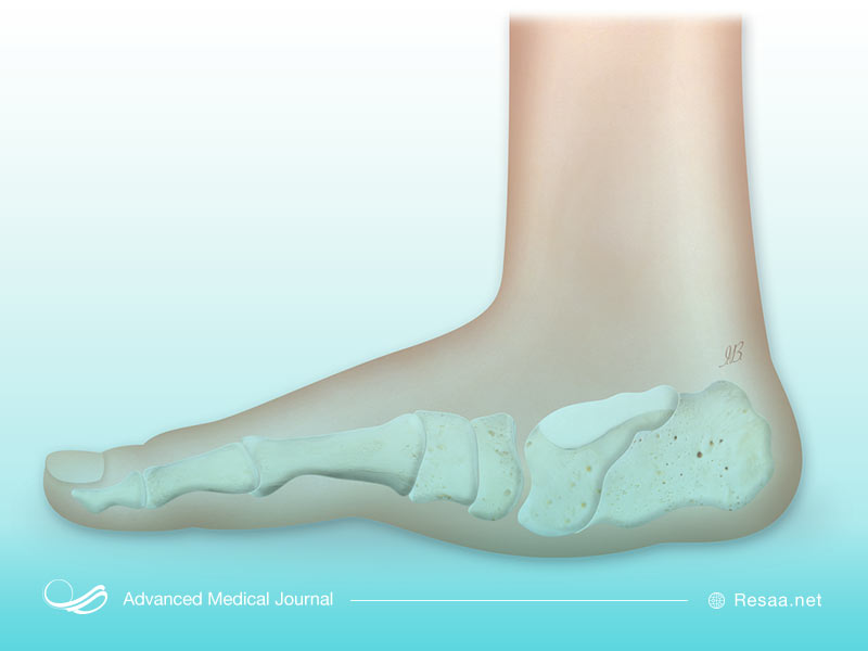 ارتروپاتی شارکو