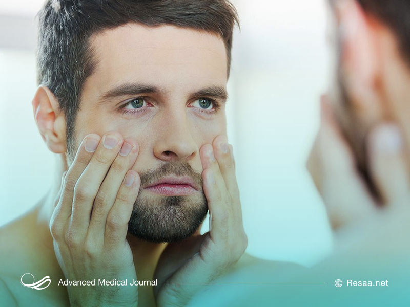 تیرگی زیر چشم