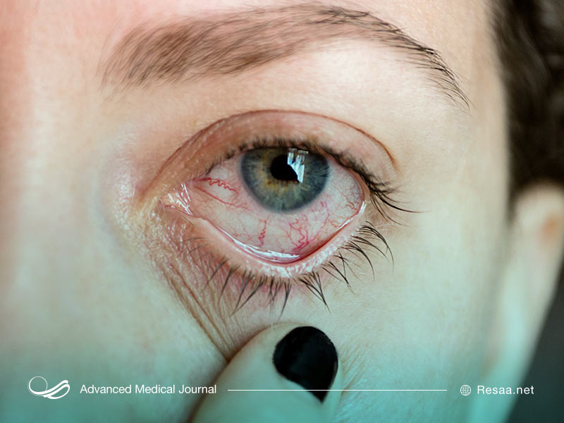 بیماری های چشمی