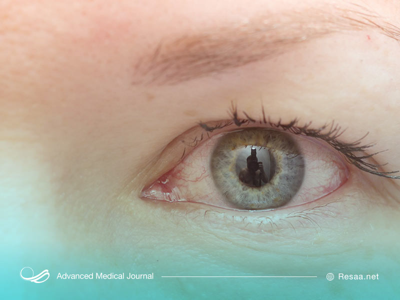 چه عاملی سبب ایجاد یوئیت می‌شود