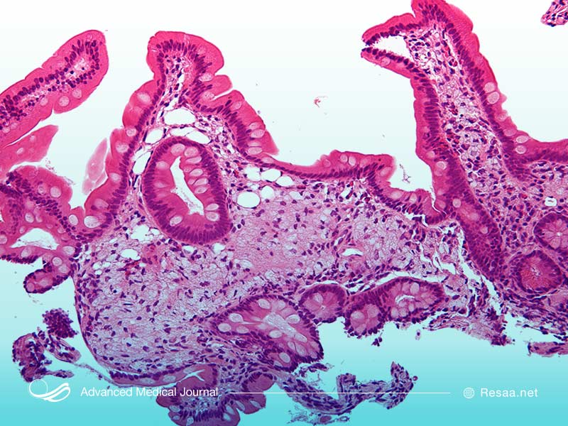 بیماری گوارشی