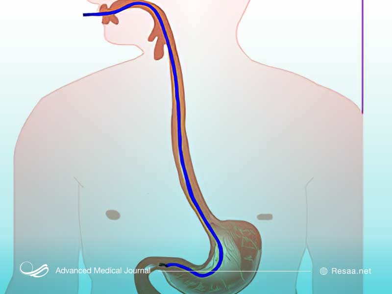 مشکل در گوارش