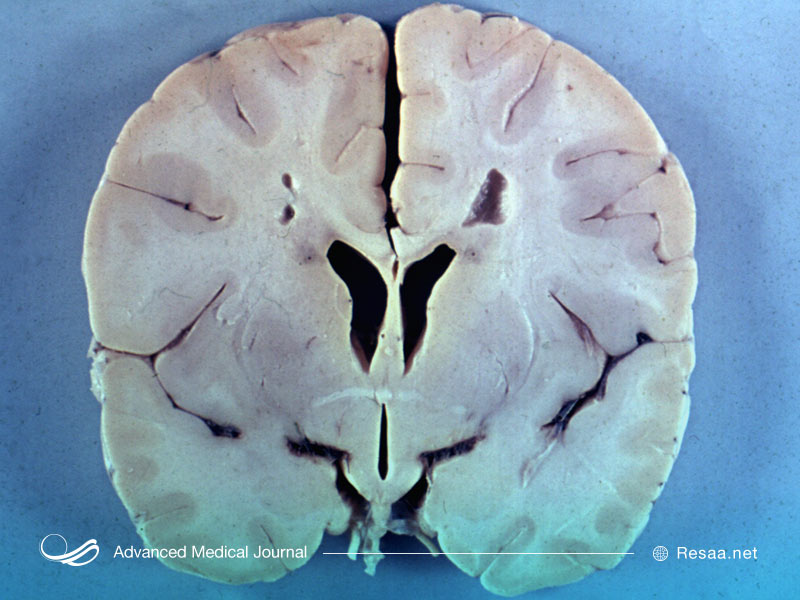 بیماری الکساندر