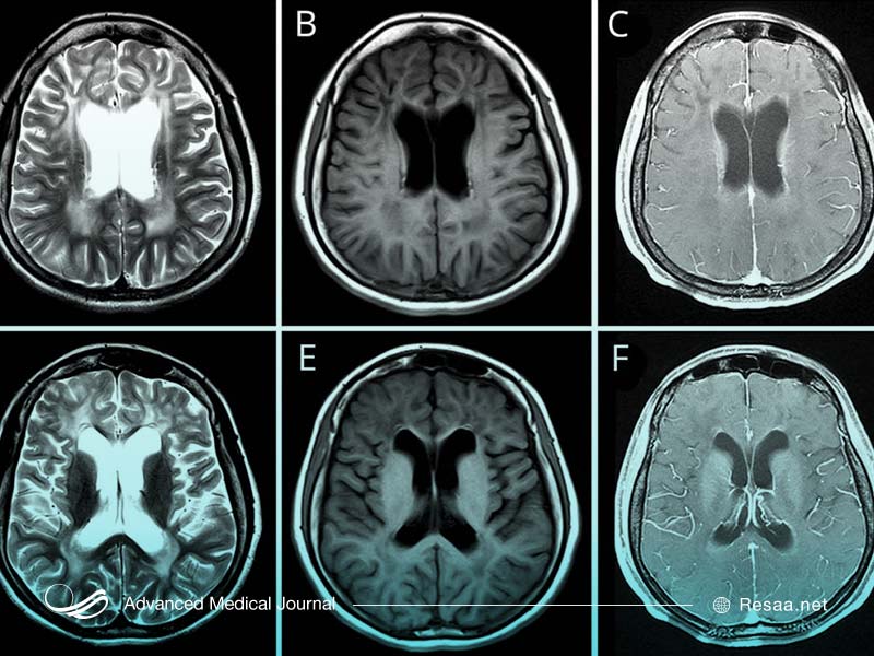 چرا به بیماری الکساندر مبتلا میشویم