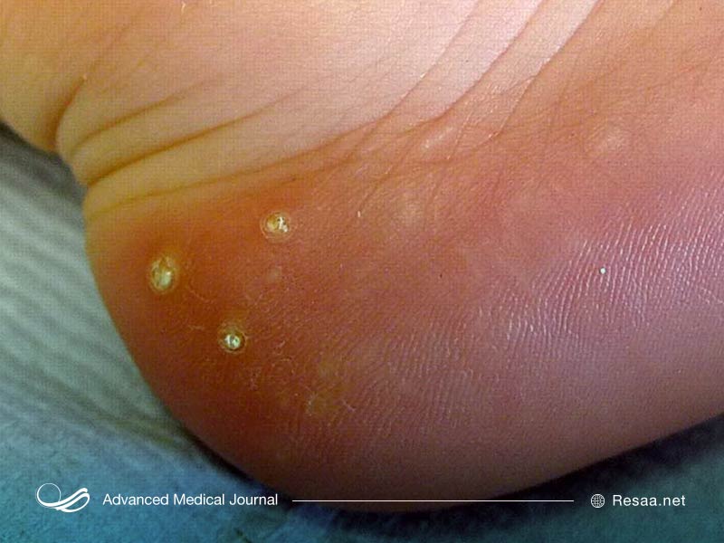 تصویر کلسیفیکیشن