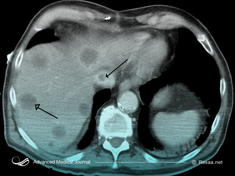بیماری کیاری