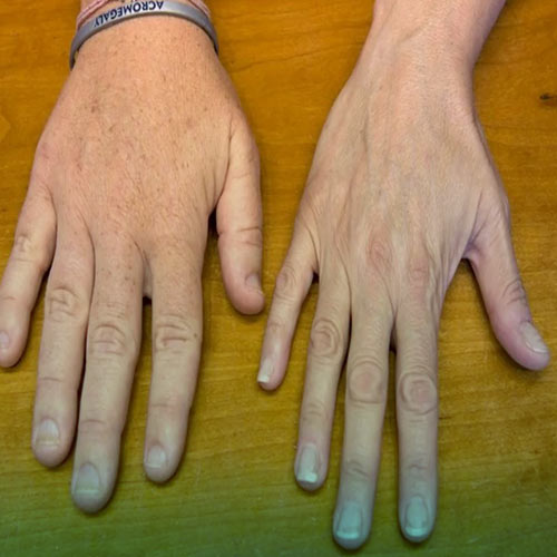 غول پیکری چیست