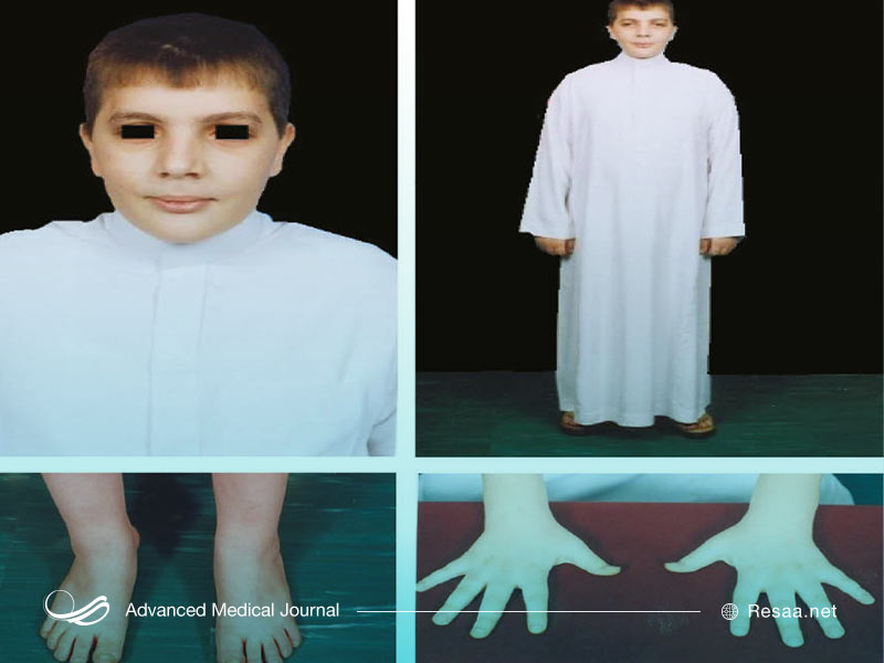 علل غول پیکری