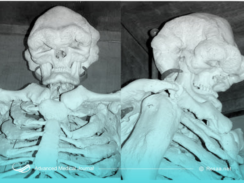 تصویر استخوان افراد غول پیکر