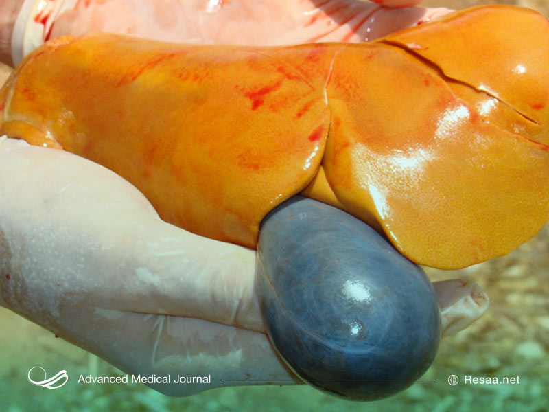 بیماری کبد بزرگ شده