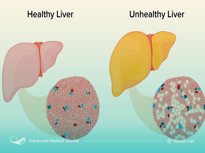 نشانه های بزرگ شدن کبد