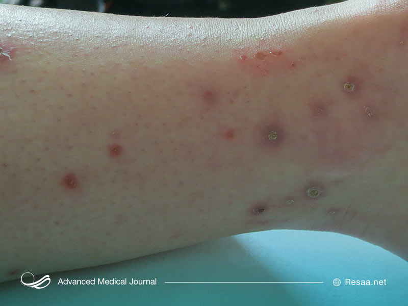 سرطان خون و هاچکین