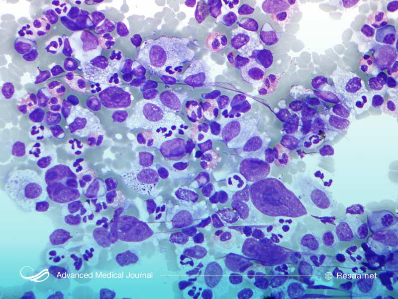 روند بیماری