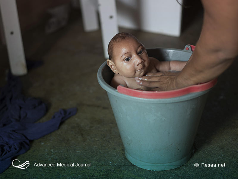 کودک مبتلا به میکروسفالی