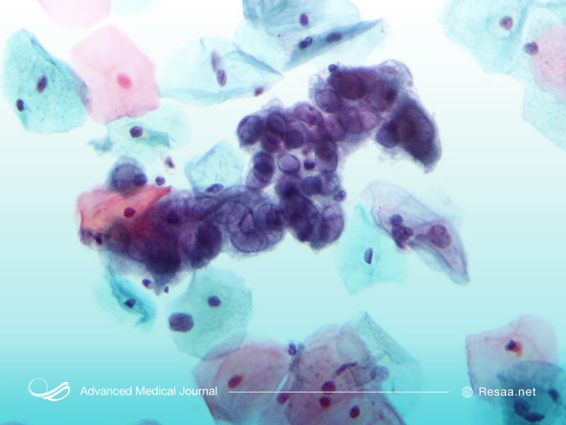 آینده بیماری توکسوپلاسموز