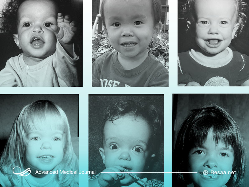 آکندروپلازی یک بیماری ارثی است