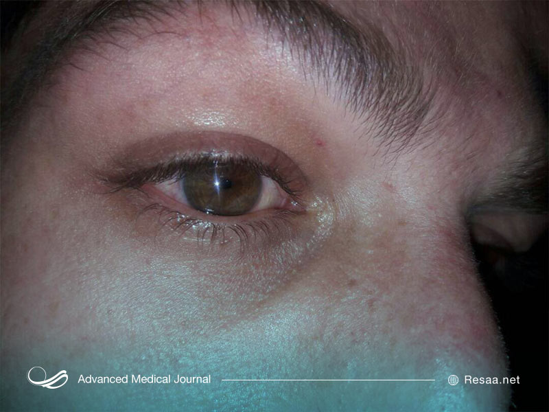 علایم بیماری pinpoint