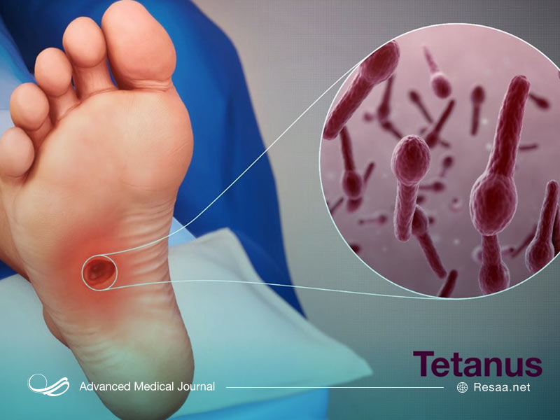 بیماری کزاز چیست