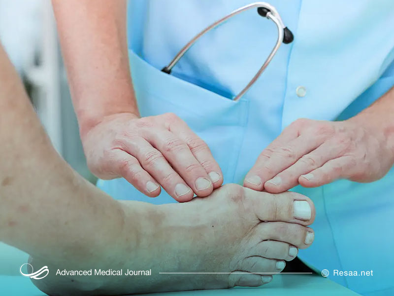 نقرس نوعی آرتروز دردناک است.