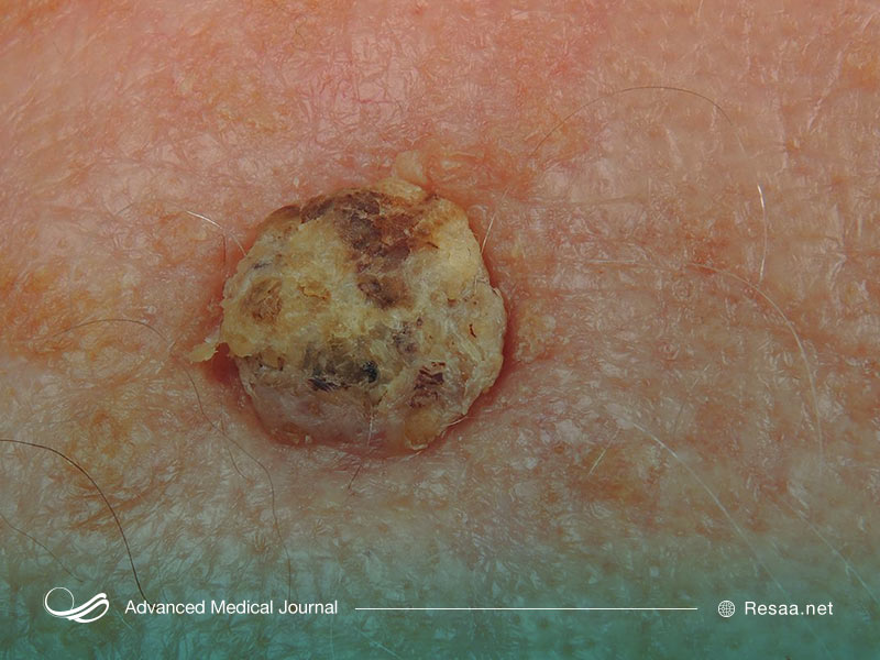 سرطان پوست انواع مختلفی دارد.