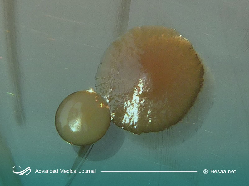 برای تشخیص بیماری از مایع نخاعی کمر نمونه برداری می‌شود.