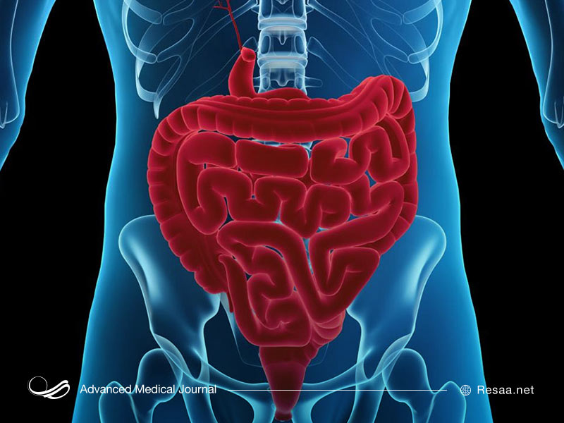 بسته شدن روده ها