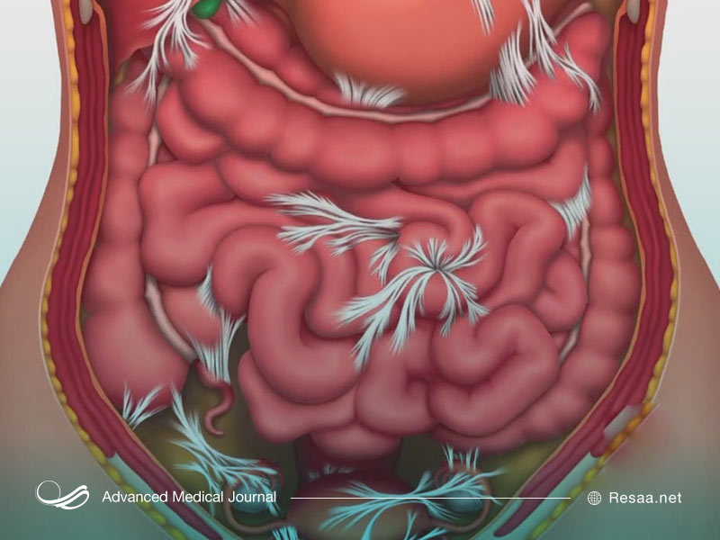 بیماری های مرتبط با انسداد روده