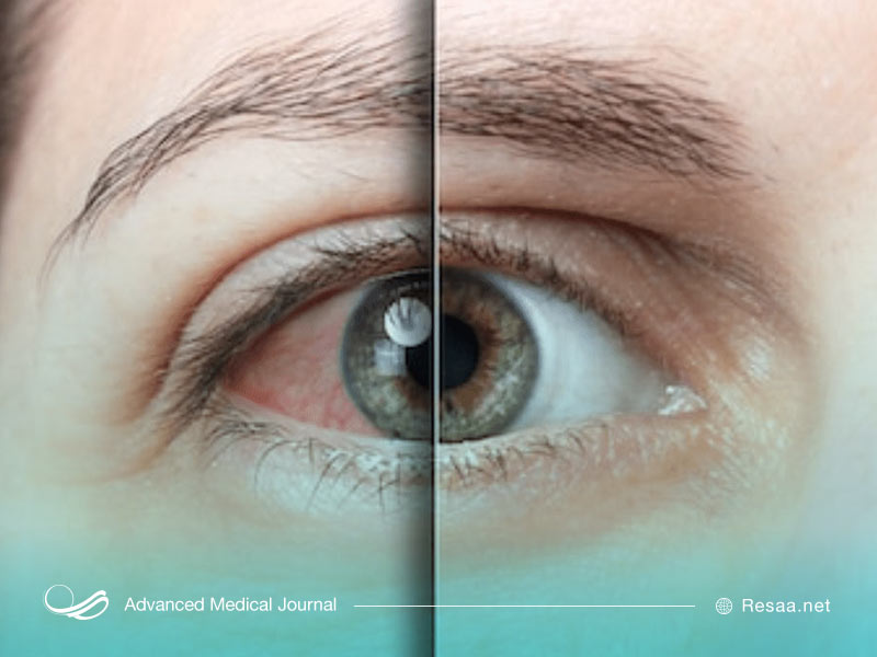 سندروم شوگرن سبب خشکی چشم و دهان می‌شود.