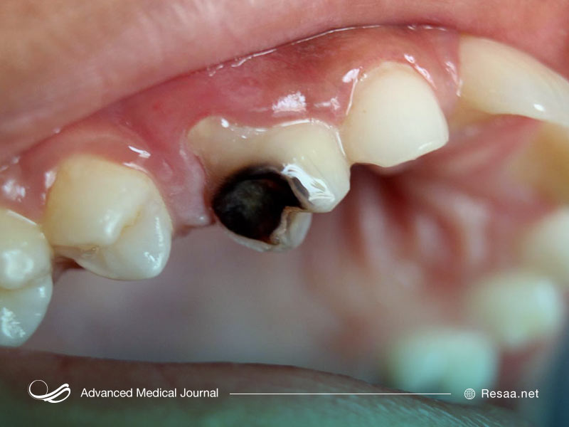 بیماری‌های مختلفی با سندروم شوگرن در ارتباط هستند مثل پوسیدگی دندان