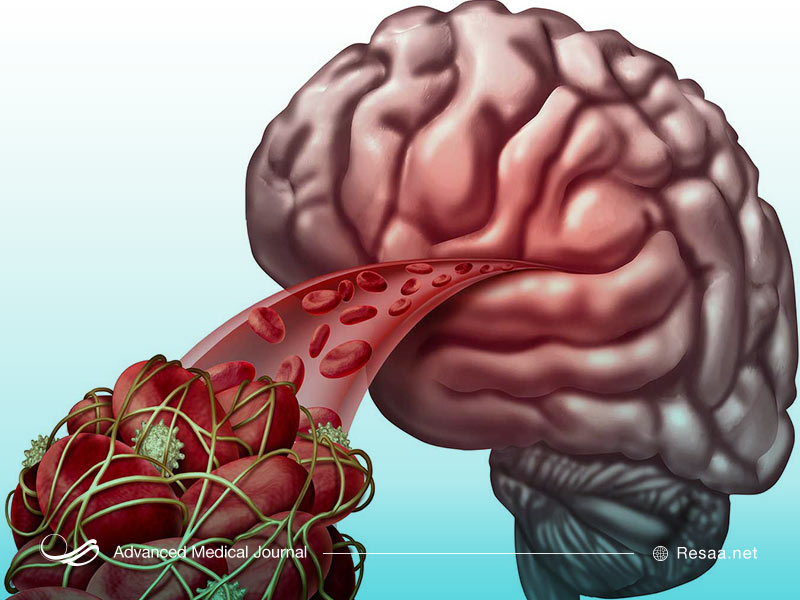 ترومبوز وریدی مغز