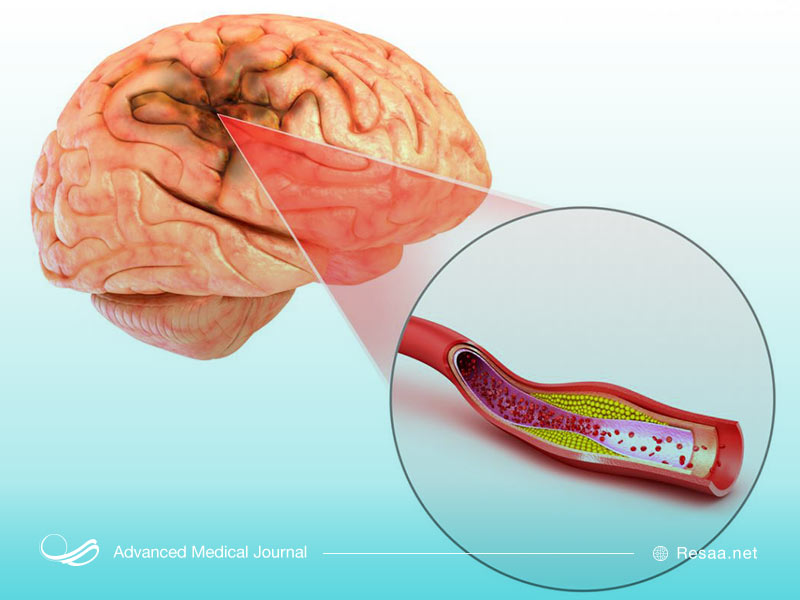 تشخیص ترومبوز مغزی
