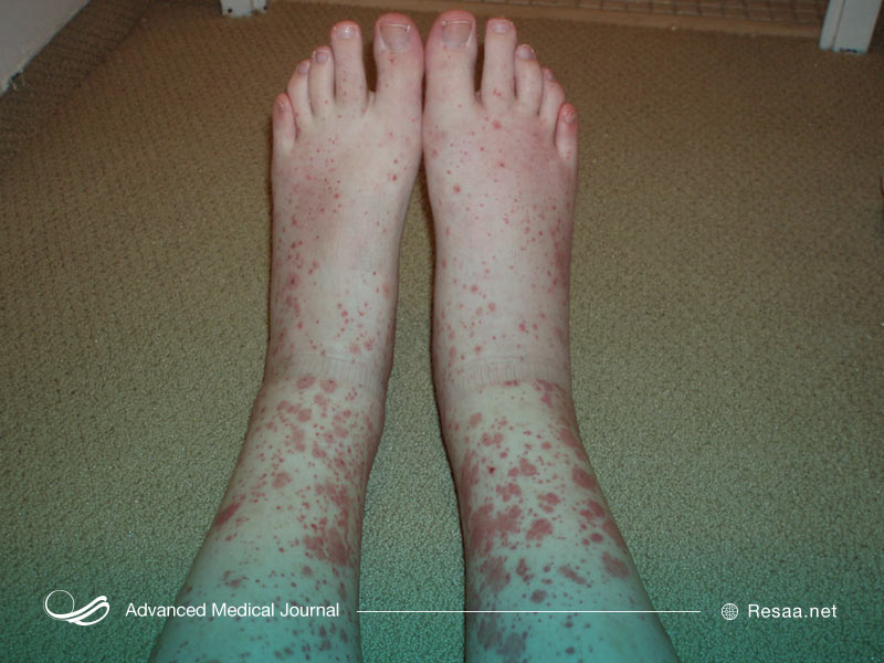 واسکولیت سبب التهاب رگ های خونی میشود.