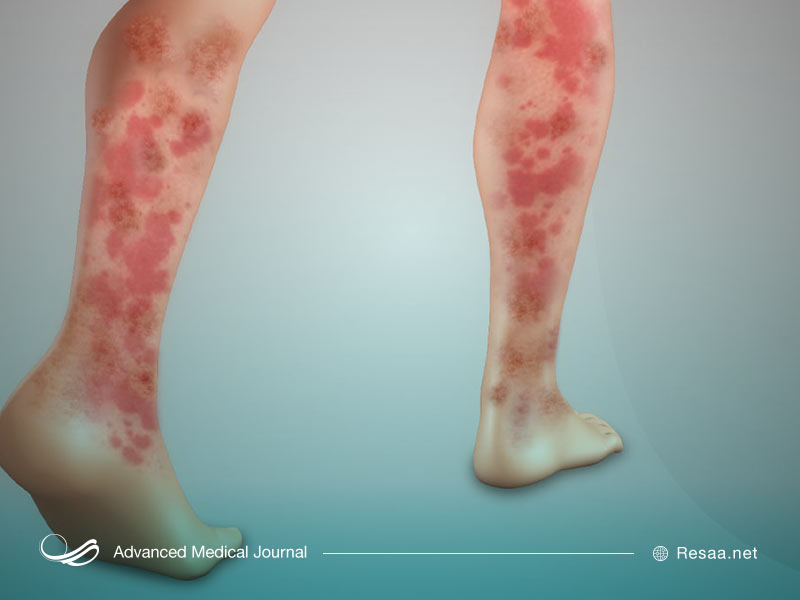 بیماری واسکولیت انواع مختلفی دارد و میتواند به بیماریهای خونی دیگر مرتبط باشد.