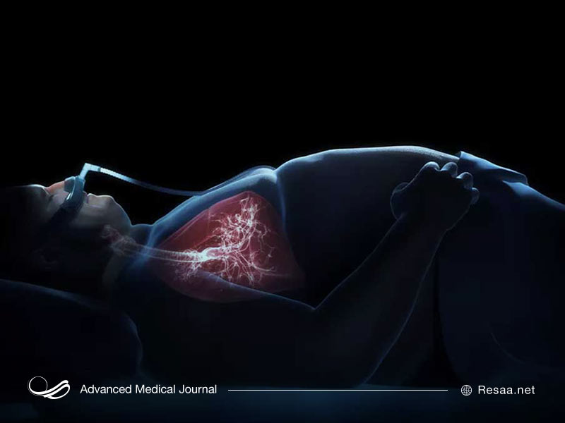 فشار خون ریوی از عوارض سندروم پیک ویگن است.