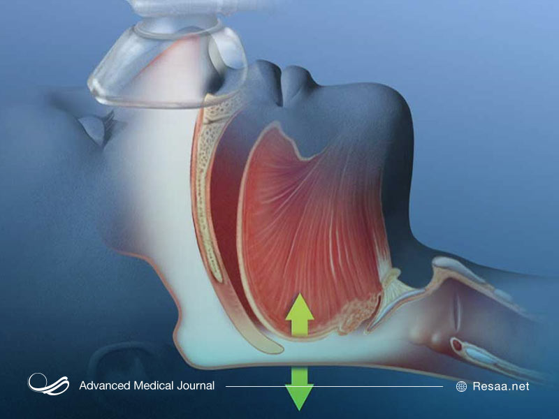 آپنه انسدادی خواب نیز از عوارض سندروم پیک ویکن است