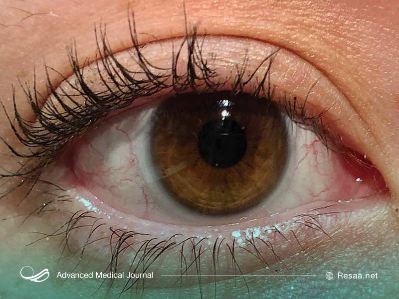 مهم‌ترین عامل در پیرچشمی سن است.