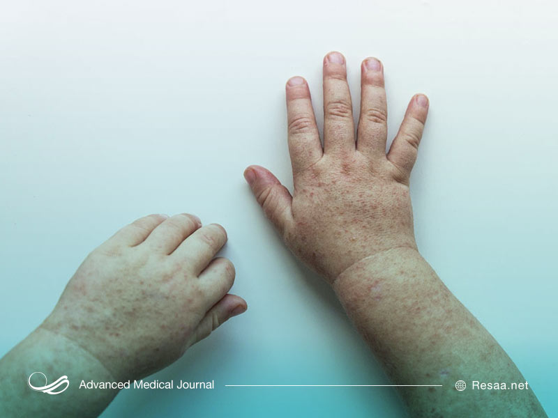 بثورات پوستی قرمزرنگ